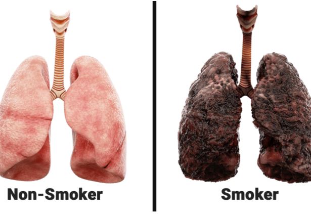 Cancer on the Lungs of a Smoker