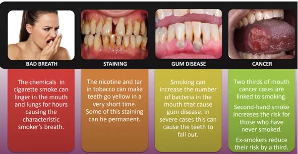 Oral health issues due to Shisha Tobacco