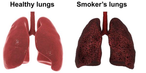 Long term Effects of Smoking on Lungs